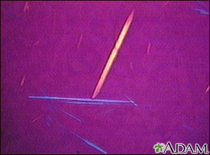 Uric acid crystals Uric acid crystals