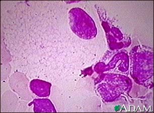 Niemann-Pick foamy cells Niemann-Pick foamy cells