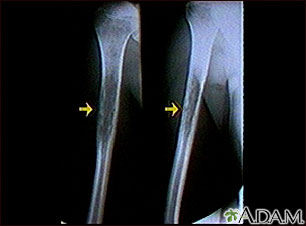 Ewing sarcoma - X-ray Ewing sarcoma - X-ray