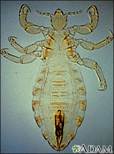 Body louse