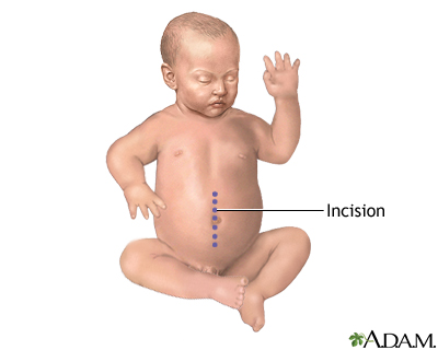 Incision Incision