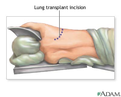 Incision Incision