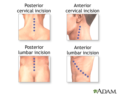 Incision Incision