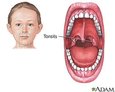 Tonsillectomy - Series Tonsillectomy - Series