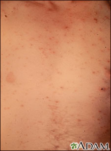Chickenpox - lesions on the chest Chickenpox - lesions on the chest