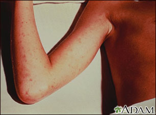 Rocky mountain spotted fever on the arm Rocky mountain spotted fever on the arm