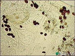 Scabies mite - photomicrograph of the stool Scabies mite - photomicrograph of the stool