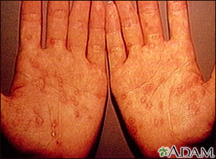 Syphilis - secondary on the palms Syphilis - secondary on the palms