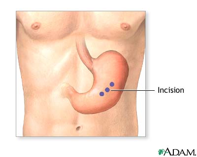 Incision Incision