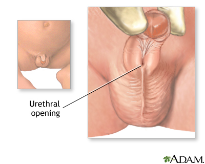 Hypospadias - Indications Hypospadias - Indications