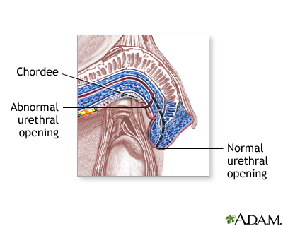 Hypospadias - Procedure Hypospadias - Procedure