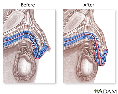 Hypospadias - Aftercare Hypospadias - Aftercare