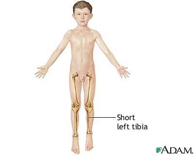 Leg lengthening - series Leg lengthening - series