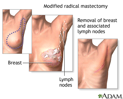 Mastectomy - Procedure part 2 Mastectomy - Procedure part 2