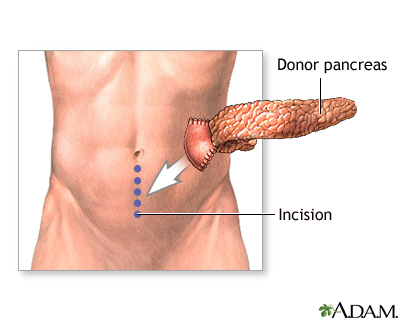 Incision Incision