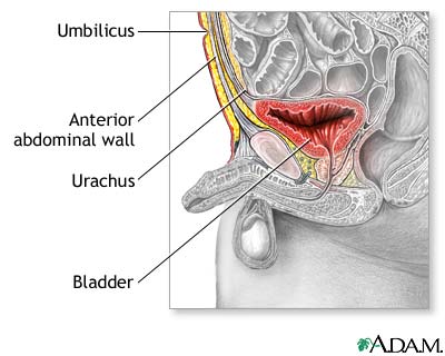 Patent urachus repair - series Patent urachus repair - series