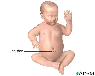 Incision Incision