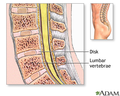 Spinal bone graft - series Spinal bone graft - series