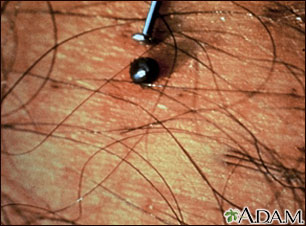 Tick - deer engorged on the skin Tick - deer engorged on the skin