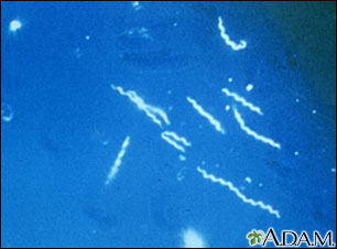 Lyme disease - Borrelia burgdorferi organism Lyme disease - Borrelia burgdorferi organism