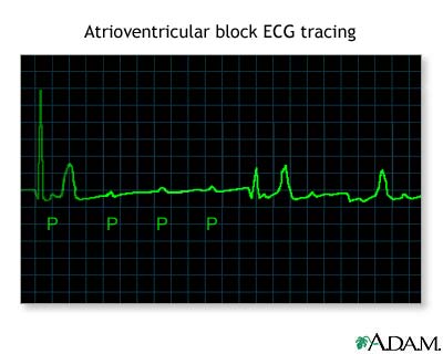 Atrioventricular block - ECG tracing Atrioventricular block - ECG tracing