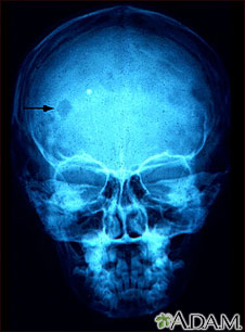 Eosinophilic granuloma - X-ray of the skull Eosinophilic granuloma - X-ray of the skull