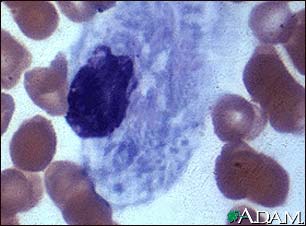 Gaucher cell - photomicrograph #2 Gaucher cell - photomicrograph #2