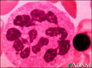 Hypersegmented PMN (Close-up) Hypersegmented PMN (Close-up)