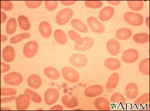 Ovalocytosis Ovalocytosis