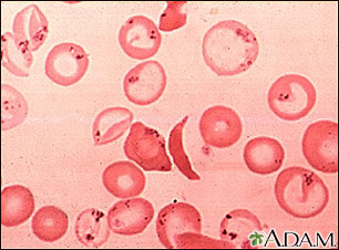 Red blood cells - sickle and Pappenheimer Red blood cells - sickle and Pappenheimer