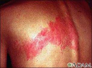 Herpes zoster (shingles) on the back Herpes zoster (shingles) on the back