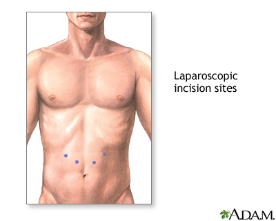 Incision Incision