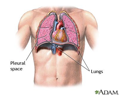 Pneumothorax - series - normal anatomy Pneumothorax - series - normal anatomy