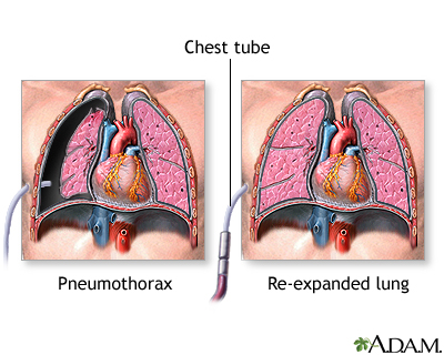 Incision Incision