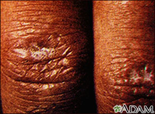 Dermatomyositis - Gottron papule Dermatomyositis - Gottron papule
