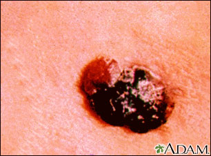 Skin cancer - raised multi-color melanoma Skin cancer - raised multi-color melanoma