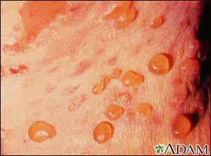 Bullous pemphigoid - close-up of tense blisters Bullous pemphigoid - close-up of tense blisters