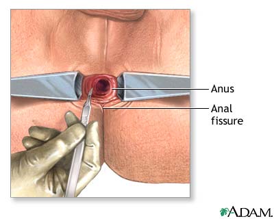 Incision Incision