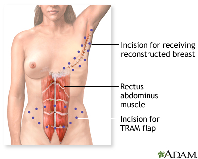 Incision Incision