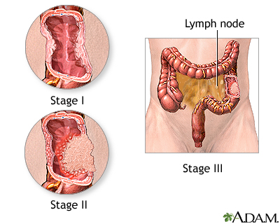 Incision Incision