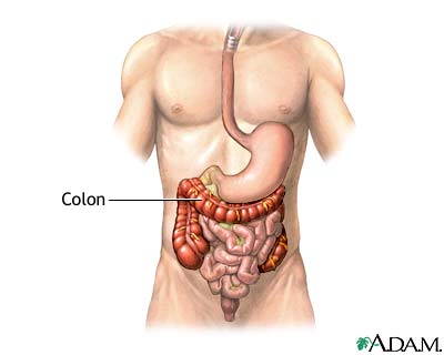 Colon diverticula - series Colon diverticula - series