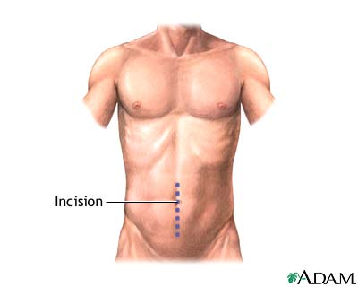 Incision Incision