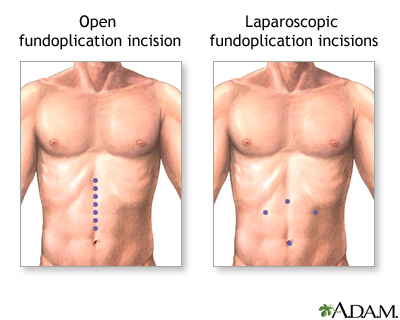 Incision Incision