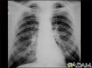 Coal workers pneumoconiosis - stage II Coal workers pneumoconiosis - stage II
