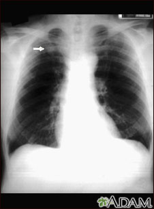 Pulmonary nodule - front view chest x-ray Pulmonary nodule - front view chest x-ray