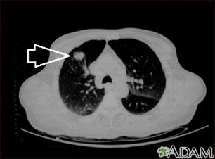 Lung mass, right upper lobe - CT scan Lung mass, right upper lobe - CT scan