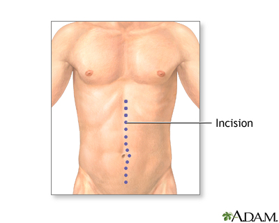 Incision Incision