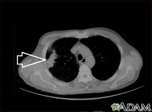 Lung mass, right lung - CT scan Lung mass, right lung - CT scan