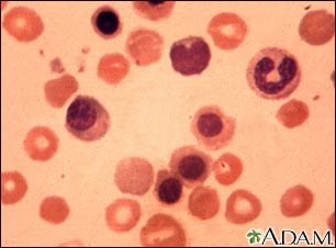 Erythroblastosis fetalis - photomicrograph Erythroblastosis fetalis - photomicrograph