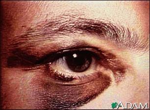 Black eye Black eye